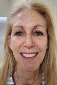 After Image: Chemical Peel for sun damage before and after