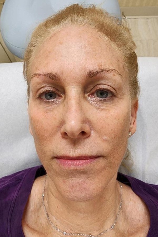 Before Image: Chemical Peel for sun damage before and after - front