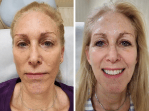 Chemical Peels Before and After