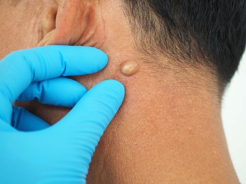 can-dermatologists-remove-cysts