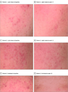 Winlevi before and after