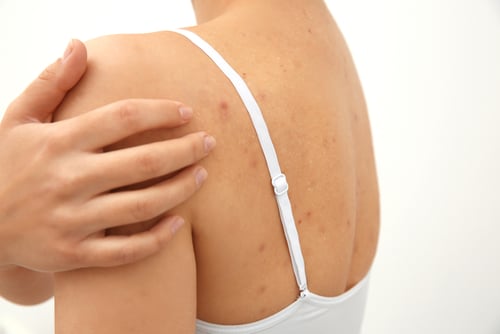 Woman scratching her shoulder with pimples on white background