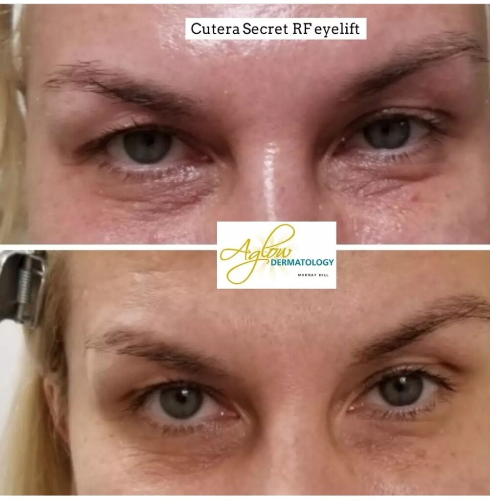 Non surgical eye lift before and after