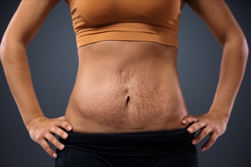 Why Do We Get Stretch Marks? - Aglow Dermatology