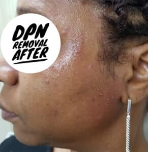 After Image: Before and After DPN Removal