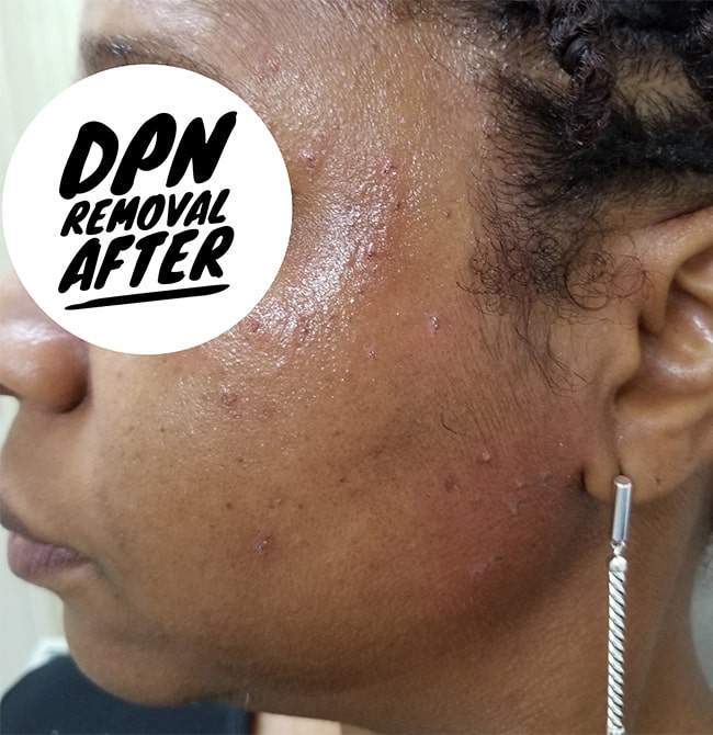 After Image: Before and After DPN Removal - left-side