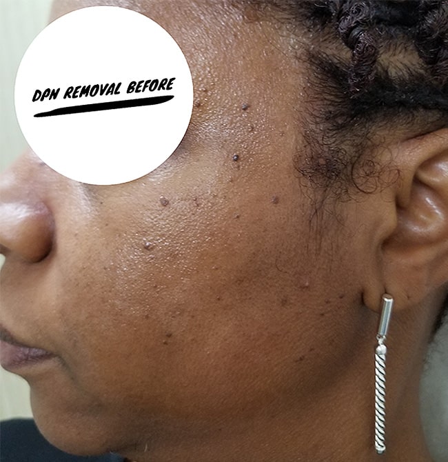 Before Image: Before and After DPN Removal - left-side