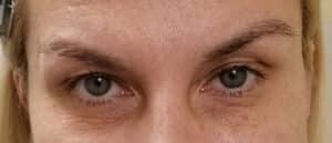 After Image: Eyelift Cutera Secret RF