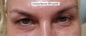 Eyelift Cutera Secret RF