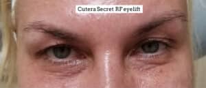 Before Image: Eyelift Cutera Secret RF