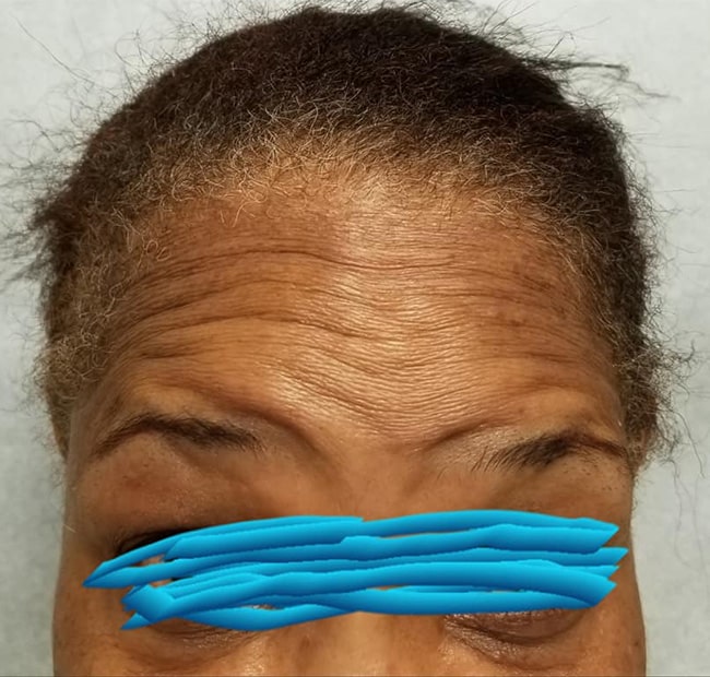Before Image: Neurotoxin - front