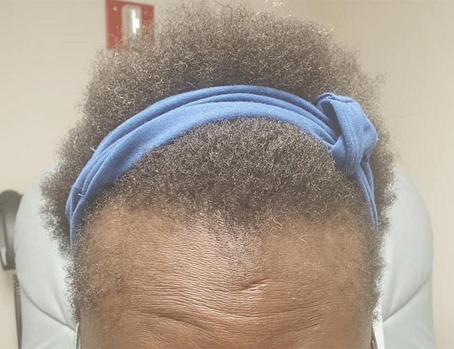 65063 traction alopecia after