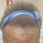 65063 traction alopecia after