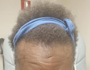 After Image: Alopecia