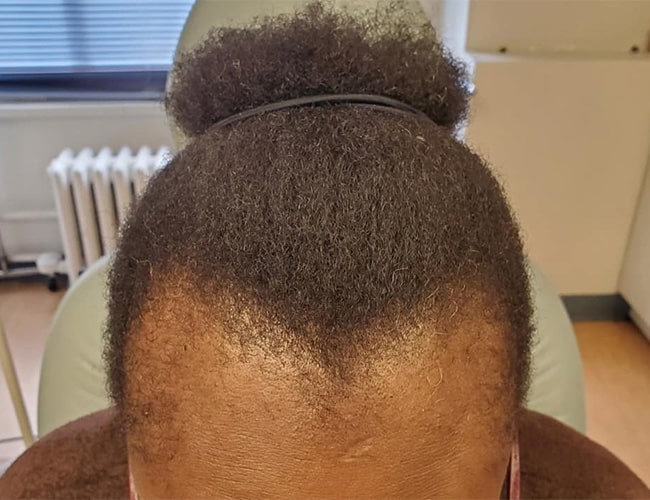 65063 traction alopecia before