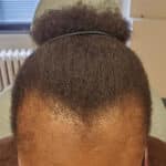 65063 traction alopecia before