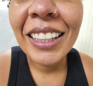 After Image: Botox for Gummy Smile