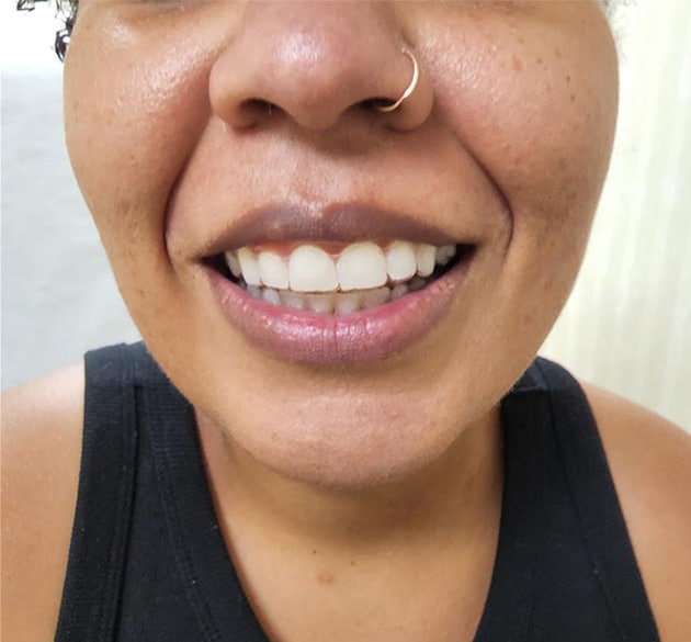 After Image: Botox for Gummy Smile - front