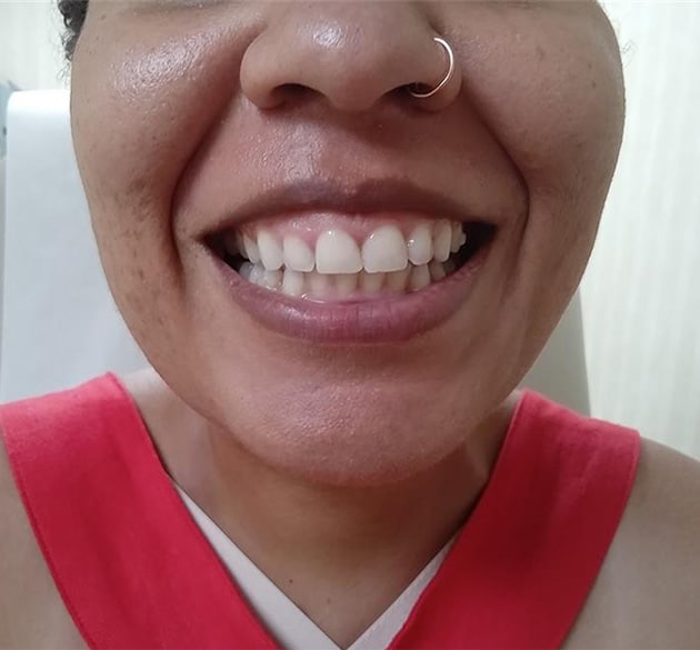 Before Image: Botox for Gummy Smile - front