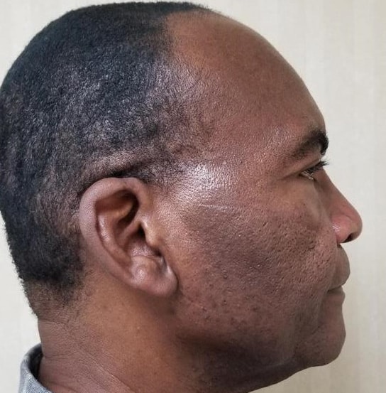 acne scar treatment as depicted by aside profile of a black man without acne scars after receving RF microneedling treatment at Aglow Dermatology.