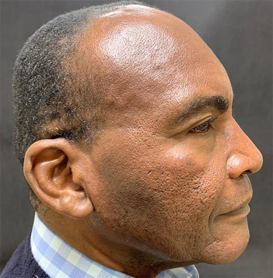 A side profile depicting a middle aged man with acne scars before receving RF microneedling treatment at Aglow Dermatology.