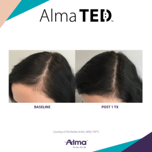 Alma TED hair restoration
