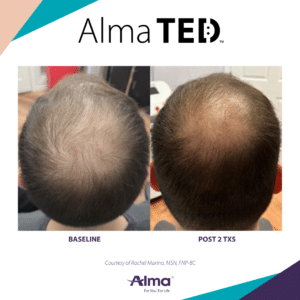 Alma TED hair restoration