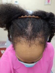 After Image: Alma TED Hair Restoration | traction alopecia