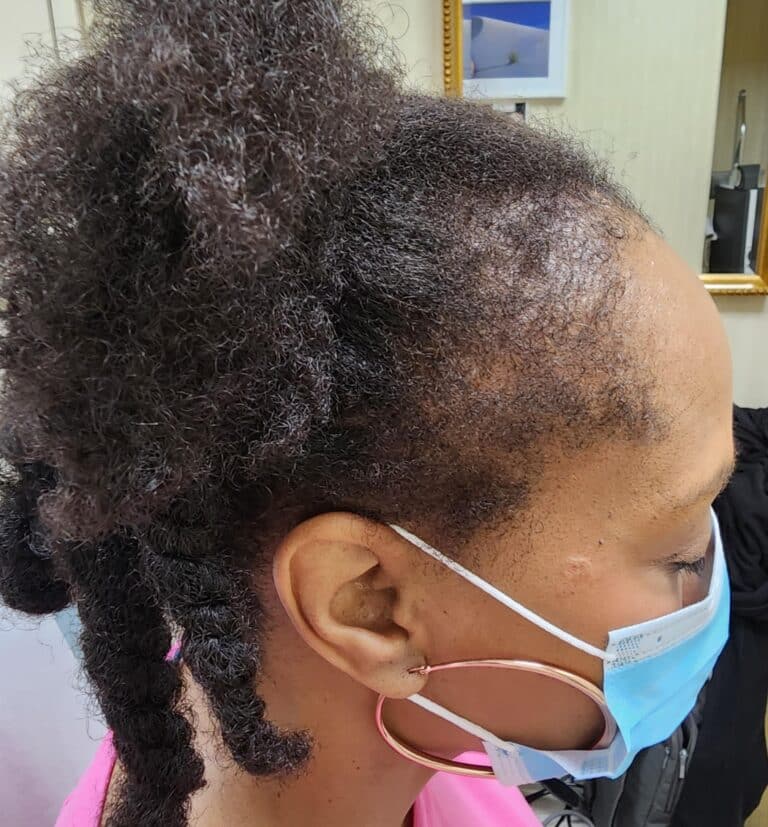 After Image: Alma TED Hair Restoration | traction alopecia - right-side