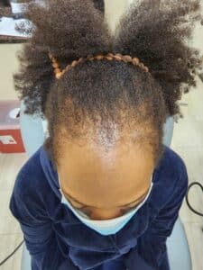 Before Image: Alma TED Hair Restoration | traction alopecia