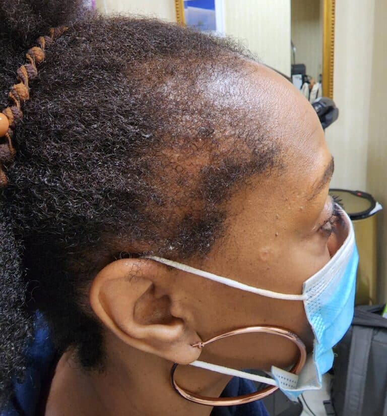 Before Image: Alma TED Hair Restoration | traction alopecia - right-side