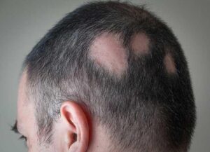 alopecia vs hair loss