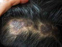 Can lupus cause hair loss