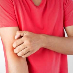 can allergies cause eczema - someone scratching their arm
