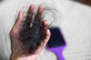 hair loss after giving birth