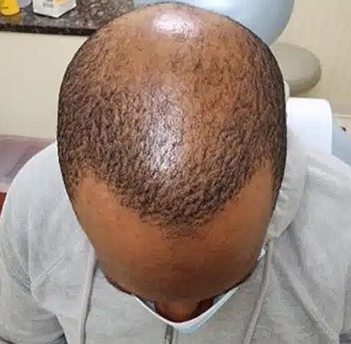 After Image: Alma TED Hair Restoration - front
