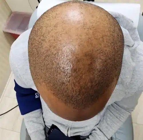 Before Image: Alma TED Hair Restoration - front