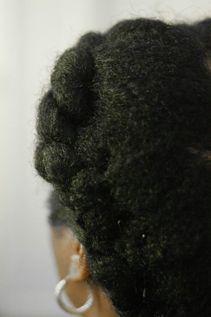seborrheic dermatitis vs dandruff as depicted by a waomn with textured hair