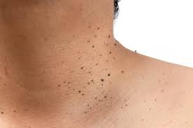 skin tags on neck