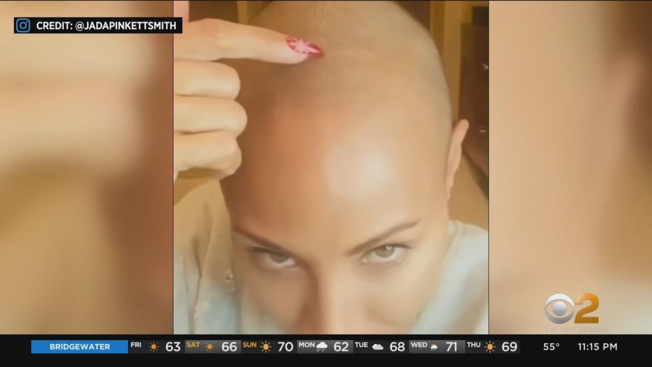alopecia areata as depicted by Jada Pinkett-Smith