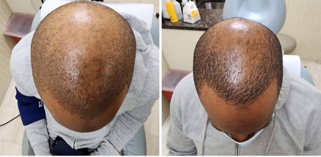 AlmaTED 2 treatments