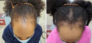 traction alopecia when is it too late as shown by a before and after