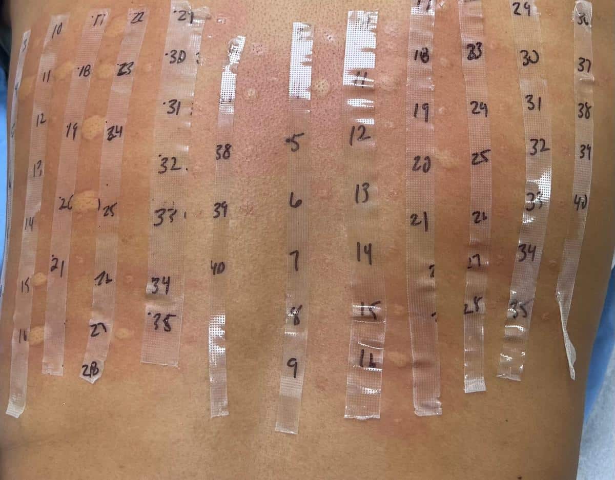 allergy test