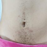 laser hair removal stomach after 1 with vi peel