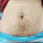 laser hair removal stomach before