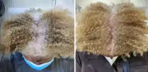 A before and after photo of a woman treated for perimenopausal hair loss at Aglow Dermatology.