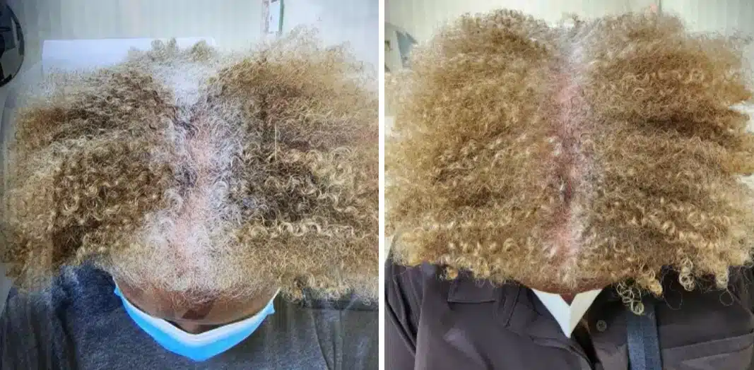 A before and after photo of a woman treated for perimenopausal hair loss at Aglow Dermatology.
