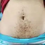 laser hair removal stomach before 1 150x150.jpg