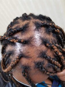 CCCA before and after gallery photo of top of head before alma ted treatment