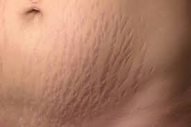 stretch mark removal in nyc as depicted by stretch marks on an abdomen